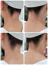 エステシェービングサロン フルール(Fleur)/うなじのビフォーアフター