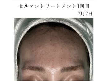 ヴィヴ 熊本(ViV)/【セルマンピーリング】before