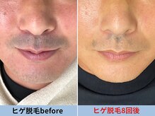 ミスターアンクール 鹿児島(Mr.uncoeur)/ヒゲ脱毛8回後