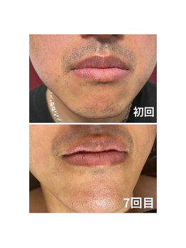 ダンニヒル(dannihil)/ヒゲ脱毛7回目