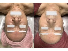 ピュリフィケーション(Purification)/ガチガチの肩周りの改善も！