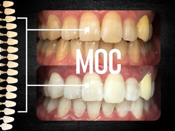 モック 麻布十番(MOC)/ホワイトニング/麻布十番/六本木
