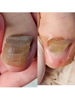 エムズリネイル(M’srenail)/肥厚爪