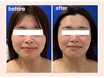 プリマヴェーラ(PRIMAVERA)/スリムフェイスライン