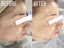 煌(kirameki)/【シミ】毛穴洗浄＋micostella