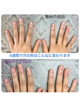 桃の木 吉祥寺店/ビフォーアフター 噛み爪ケア