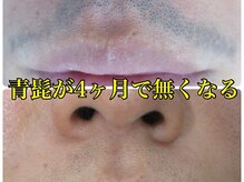 美容脱毛専門サロン エピラージュ 新宿店(Epilage)/刺激が少ないのに早い効果！