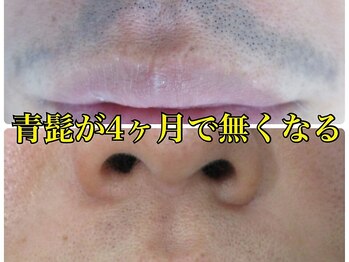 美容脱毛専門サロン エピラージュ 新宿店(Epilage)/刺激が少ないのに早い効果！