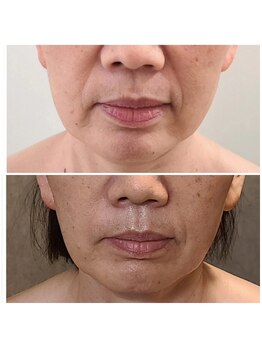 ウォーマル(warmaL)/小顔矯正/ほうれい線も軽減！