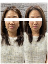 長寿鍼灸院 長寿整骨院/ハリネズミ女優美容鍼効果★