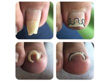 厚木 海老名 巻き爪矯正センター/事例【ツメフラ法巻き爪矯正】