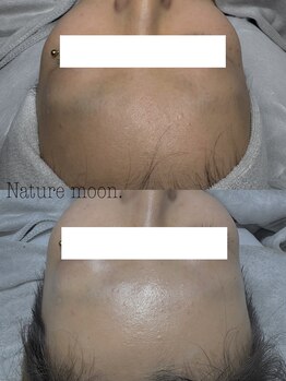 ナチュールムーン(Nature moon.)/毛穴洗浄・ハーブピーリング