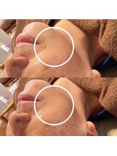 ひっそり美肌構築/ほうれい線薄く♪