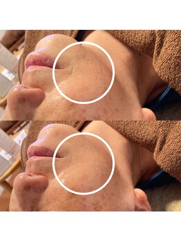 ひっそり美肌構築/ほうれい線薄く♪