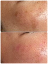 ママナ(mamana)/取れた～ホワイトラボ