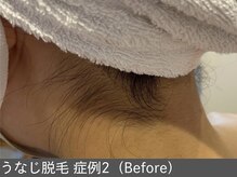 オアシスラグーン(OASIS LAGOON)/うなじ脱毛（症例2 before）