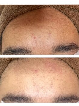 エピ エピ プラス イオンモール宇城店(EPI*EPI+)/子供脱毛 Before→After