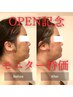 新規モニター特価◎術後ケアインディバ【顔40分】定価17,600円