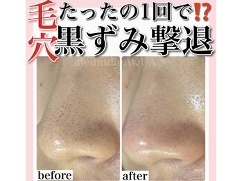 ホワイトアクア 梅田本店(WHITE AQUA)/ハーブピーリング/大阪/梅田