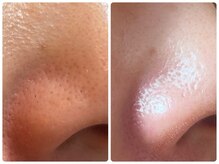 ルアーナ(Luana)/毛穴の黒ずみ　ハーブピーリング