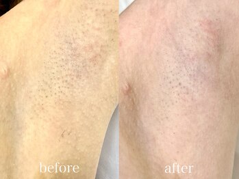 ルーム バイ マナ(room by 麻奈)/『脇脱毛』before→after