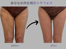 プレリー 自由が丘店/術後ケア　ラフォス