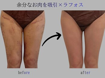 プレリー 自由が丘店/術後ケア　ラフォス