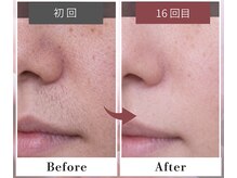 フルリール/【毛穴＋顔脱毛＋ビタミン導入】