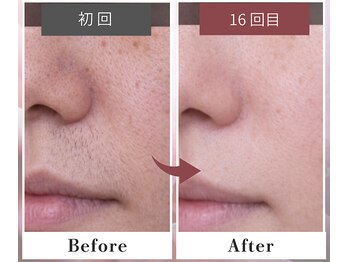 フルリール/【毛穴＋顔脱毛＋ビタミン導入】