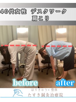 たすき鍼灸院 浦和/40代女性肩こり