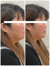 長寿鍼灸院 長寿整骨院/美容鍼25本の効果★小顔効果