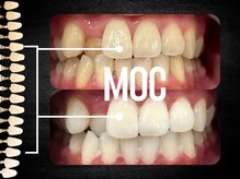 モック 麻布十番(MOC)/ホワイトニング/麻布十番/六本木