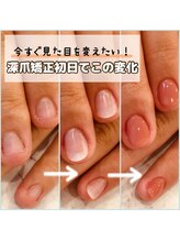 リファーレ(RIFARE)/【深爪矯正】当日から大変化！