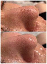 ディア(DiA)/毛穴汚れ、ざらつきすっきり！