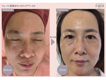 リノア 堀江(Linoa)/5ヶ月後 before→after