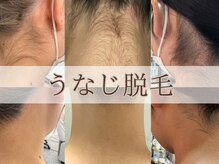 ヴィヴィオドット(vivio.)/うなじ脱毛