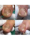 【巻き爪/陥入爪】