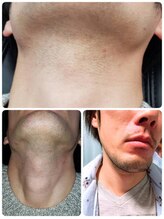 リヤン デコール 鶴ヶ島店(Lien decor)/清潔感up♪メンズひげ脱毛