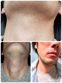 リヤン デコール 鶴ヶ島店(Lien decor)/清潔感up♪メンズひげ脱毛