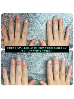 桃の木 吉祥寺店/ビフォーアフター ハリ弾力ケア