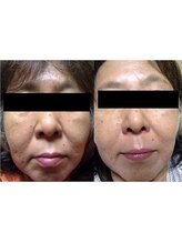 モンクラッシー(Mon classy)/ほうれい線にも◎