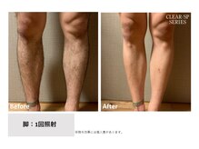 ハナフク(hanafuku)/before→after