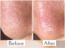 ニコリ(NICOLI)/深さがある毛穴もお任せください