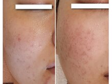 マロン(MARON)/頬ニキビ／ハーブピーリング