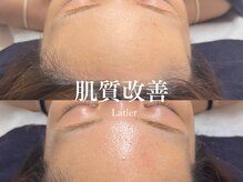 ラティエ(Latier)/くすみ徹底ケア◎透明感UP