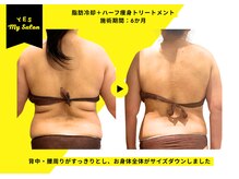 イエス マイサロン(yes My Salon)/脂肪冷却＋痩身施術症例