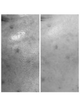 ディープブルー(Deep Blue)/プラペンデュアル×臍帯