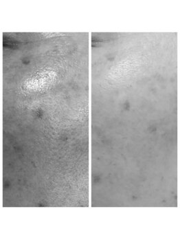 ディープブルー(Deep Blue)/プラペンデュアル×臍帯