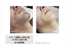 グランデ(Grande)/メンズヒゲ脱毛効果◎