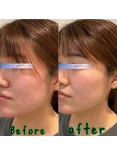 ピエール ナリタイラボ(Piel NARITAI LABO)/小顔と肌